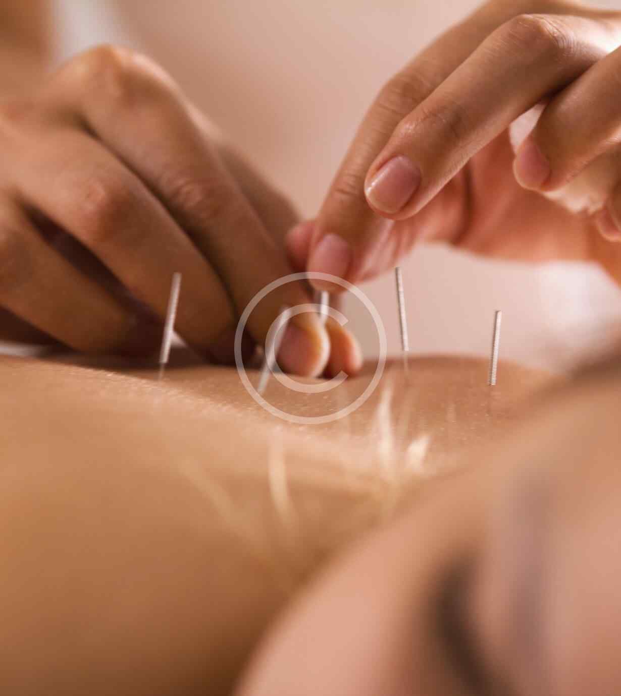 Acupuncture